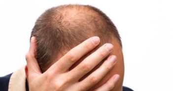 La mitad de hombres jóvenes pierden cabello por estrés y hormonas