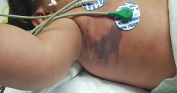 Fallece bebé de 10 meses en Nayarit por mordida de araña