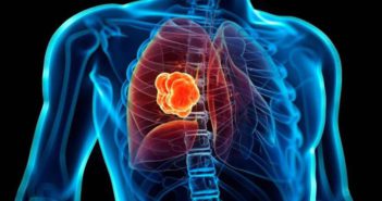 Innovadora terapia para cáncer de pulmón triplica supervivencia de pacientes
