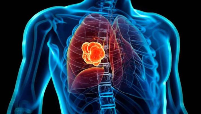 Innovadora terapia para cáncer de pulmón triplica supervivencia de pacientes