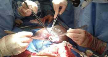 Paraguay aprueba nueva ley trasplantes para elevar donación de órganos