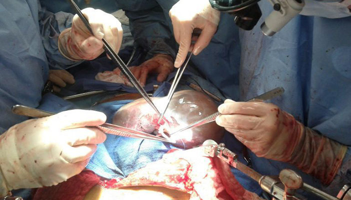 Paraguay aprueba nueva ley trasplantes para elevar donación de órganos