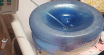 A falta de recursos, Centro de Salud usa garrafón como incubadora