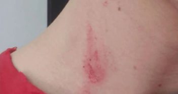 ¿Chupetón o cortada? Pidió una opinión y... "Amigo, date cuenta"