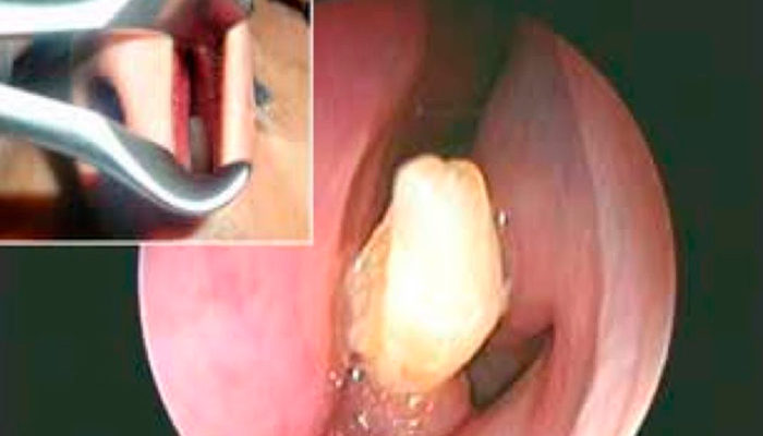 No podía percibir olores, había crecido ¡un diente dentro de su nariz!