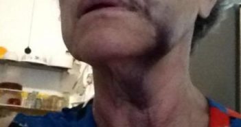 Turista recibe golpiza en asalto en Bucerías