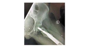 Por tobogán en Caletas, turista sufre discapacidad del 60%