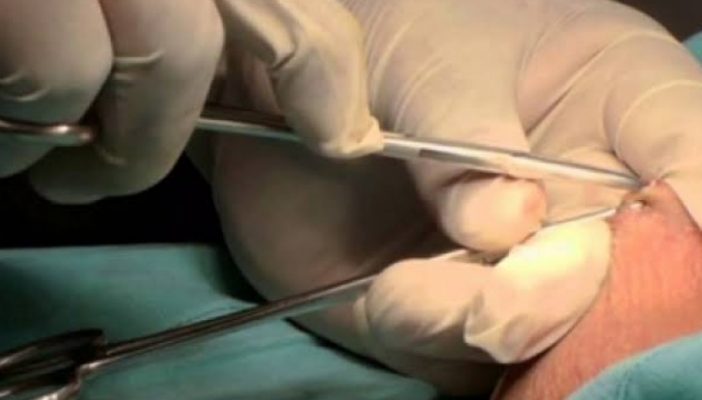 Intensifica SSJ vasectomías sin bisturí del 17 al 28 de junio 2019