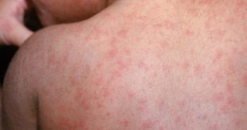 Confirmados 2 casos más en México... de sarampión