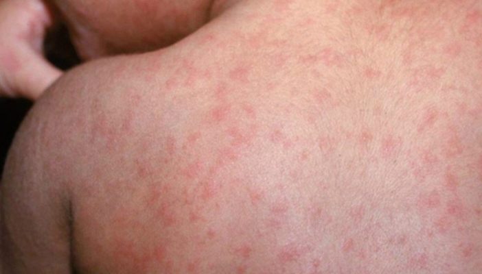 Confirmados 2 casos más en México... de sarampión