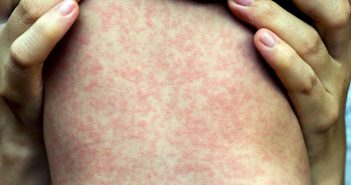 El sarampión se convierte en otro problema serio para México