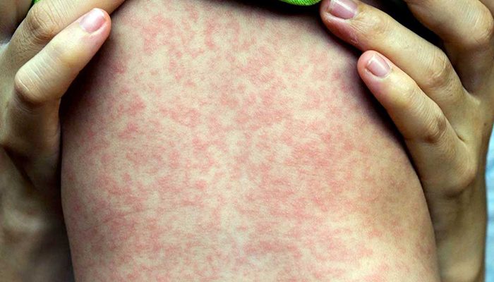 El sarampión se convierte en otro problema serio para México