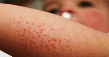 Suman 150 casos de sarampión en México