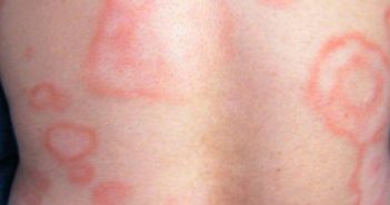 A pesar de casos de lepra en México, no hay alerta sanitaria