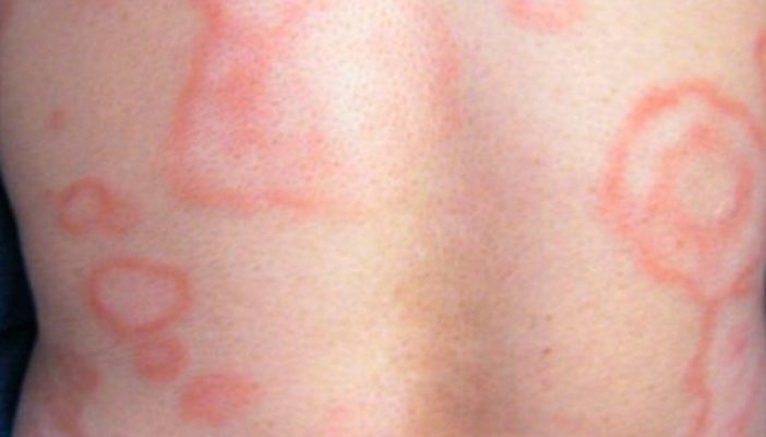 A pesar de casos de lepra en México, no hay alerta sanitaria