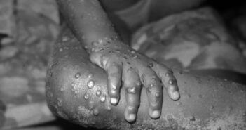 Primer caso de la viruela del mono ya llegó a México