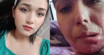 Joven pide ayuda; fue levantada y le quemaron el 30% del cuerpo