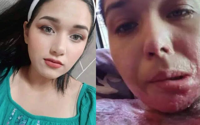 Joven pide ayuda; fue levantada y le quemaron el 30% del cuerpo