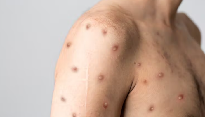 No hay emergencia sanitaria en Jalisco por viruela del mono