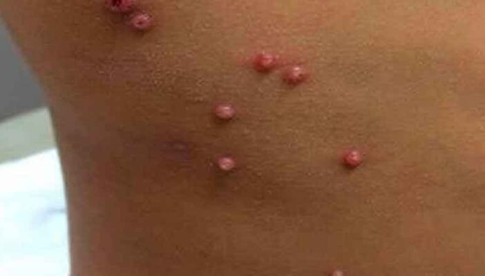 Confirman 6 casos más de la viruela del mono en Jalisco