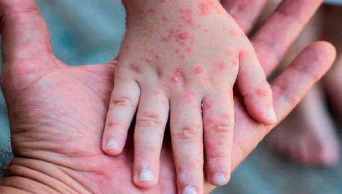 Identifican 15 casos más de la viruela símica en Jalisco