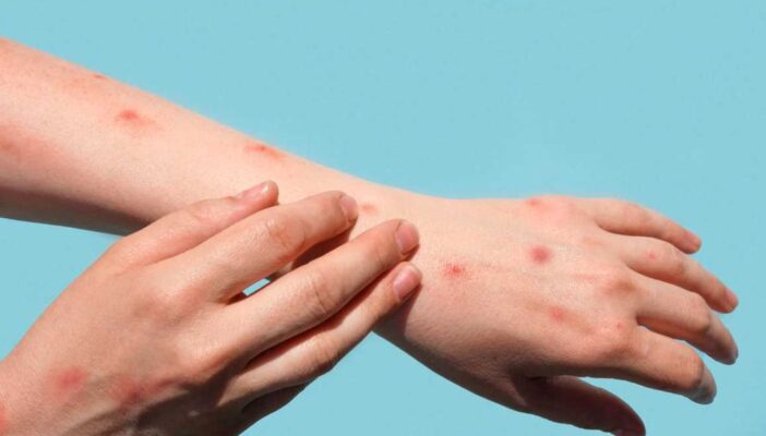 Detectan 5 casos más de viruela símica en Jalisco