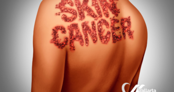 ¿Cómo empieza el cáncer de la piel?