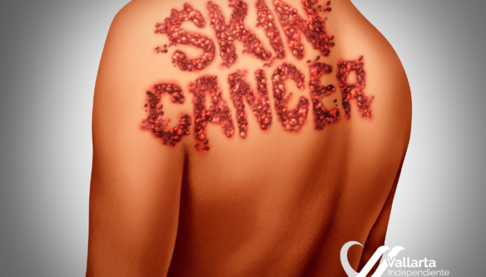 ¿Cómo empieza el cáncer de la piel?