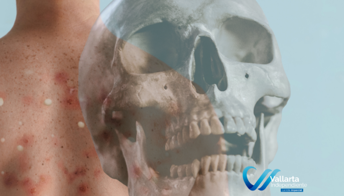 casos de mpox en jalisco