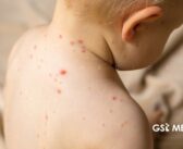 México recibe prórroga de la OPS para contener brote de sarampión