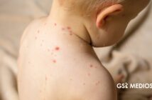 México recibe prórroga de la OPS para contener brote de sarampión