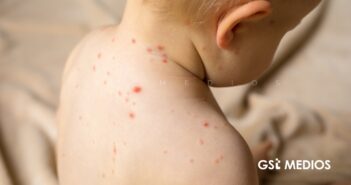 México recibe prórroga de la OPS para contener brote de sarampión