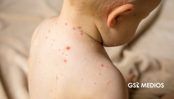 México recibe prórroga de la OPS para contener brote de sarampión