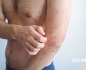 Jalisco registra tercera muerte por sarampión