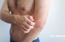 Jalisco registra tercera muerte por sarampión