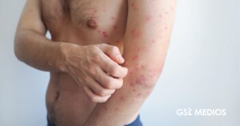 Jalisco registra tercera muerte por sarampión