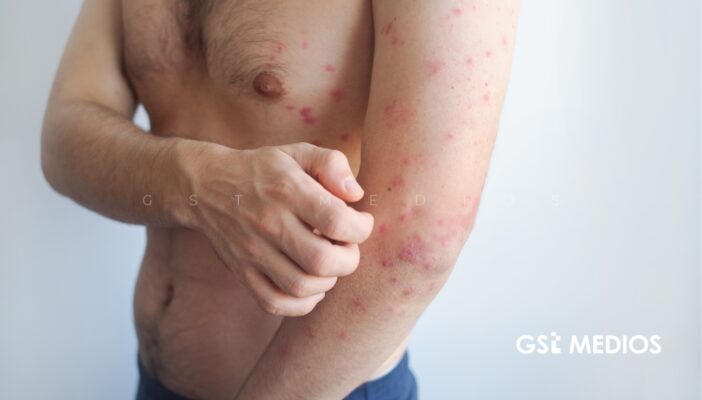 Jalisco registra tercera muerte por sarampión