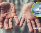 Se registran casi mil nuevos casos de Sarampión en los primeros días de febrero