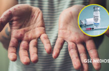 Se registran casi mil nuevos casos de Sarampión en los primeros días de febrero