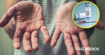 Se registran casi mil nuevos casos de Sarampión en los primeros días de febrero