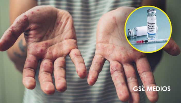 Se registran casi mil nuevos casos de Sarampión en los primeros días de febrero